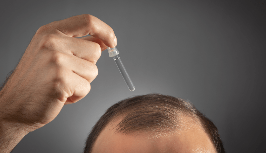 Τέλος η φαλάκρα; Νέος φυτικός ορός από την Κίνα συνδέεται με επανεμφάνιση μαλλιών...